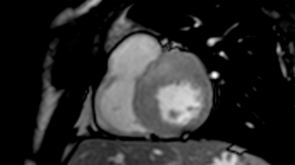 Cardiac magnetic resonance imaging (short axis view) of a patient affected by HCM