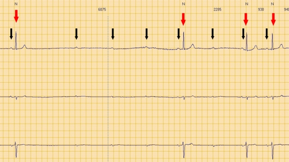 Red arrows: QRS (ventricular electrical activity). Black arrows: P waves (atrial electrical activity).  Consecutive P waves care not followed by QRS, leading to a transient asystolic pause.