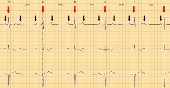Red arrows: QRS (ventricular electrical activity). Black arrows: P waves (atrial electrical activity). Atrial and ventricular activity is completely dissociated.